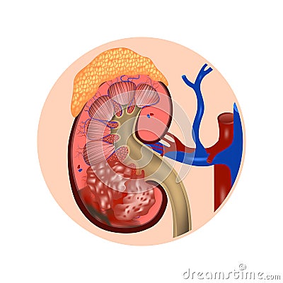 Kidney in section with a cancerous tumor and adrenal gland. Vector Illustration